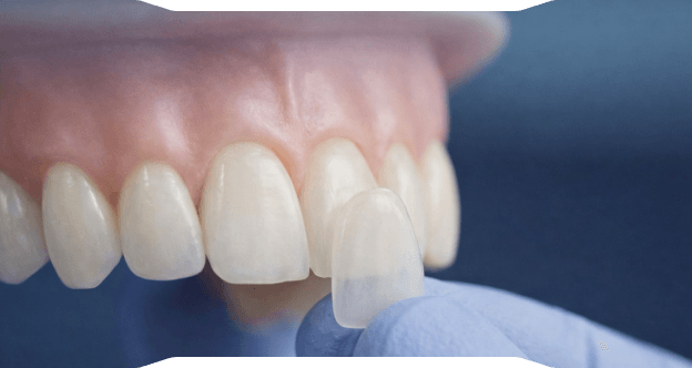 Diş Kesimi Olmadan Mükemmel Estetik:,[object Object], Yaprak Porselen (Lamine) ile Doğal ve Beyaz Gülüşler