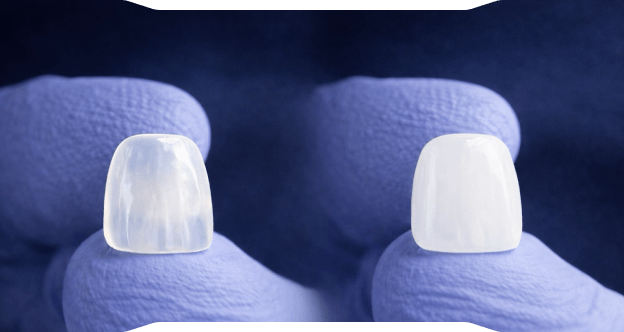 Zirkonyum mu E-max mi?,[object Object], Kaplamalarda Doğru Seçim Rehberi