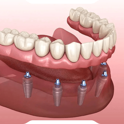 All on 4, All-on 6 İmplant Sistemleri