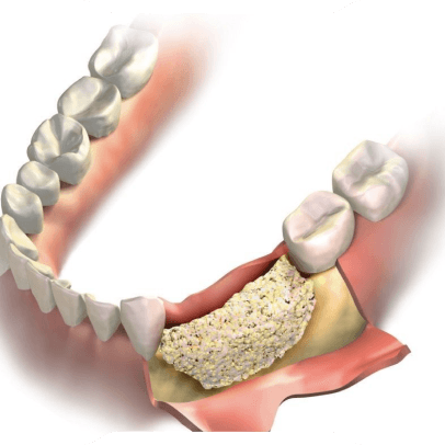 Kemik Grefti (Kemik Tozu) Uygulamaları