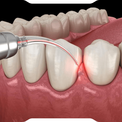 Diş Eti Estetiği (Pembe Estetik)