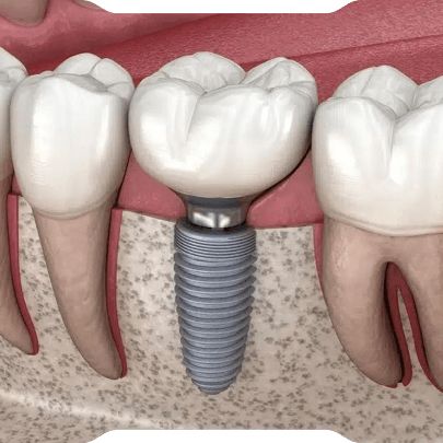 İmplant Üstü Protezler