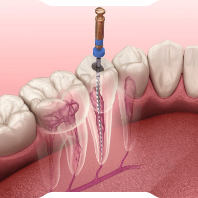 Kanal Tedavisi (Endodonti)