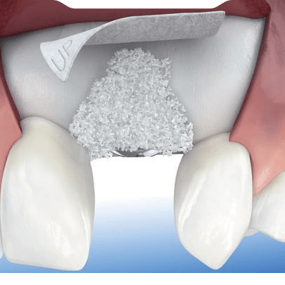 Sinüs Lifting (Sinüs Yükseltme)