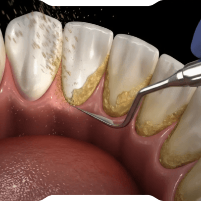 Diş Taşı Temizliği (Detertraj)